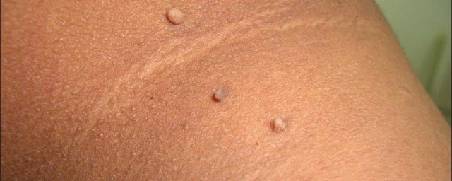 Acanthosis Nigricans & Skin Tags