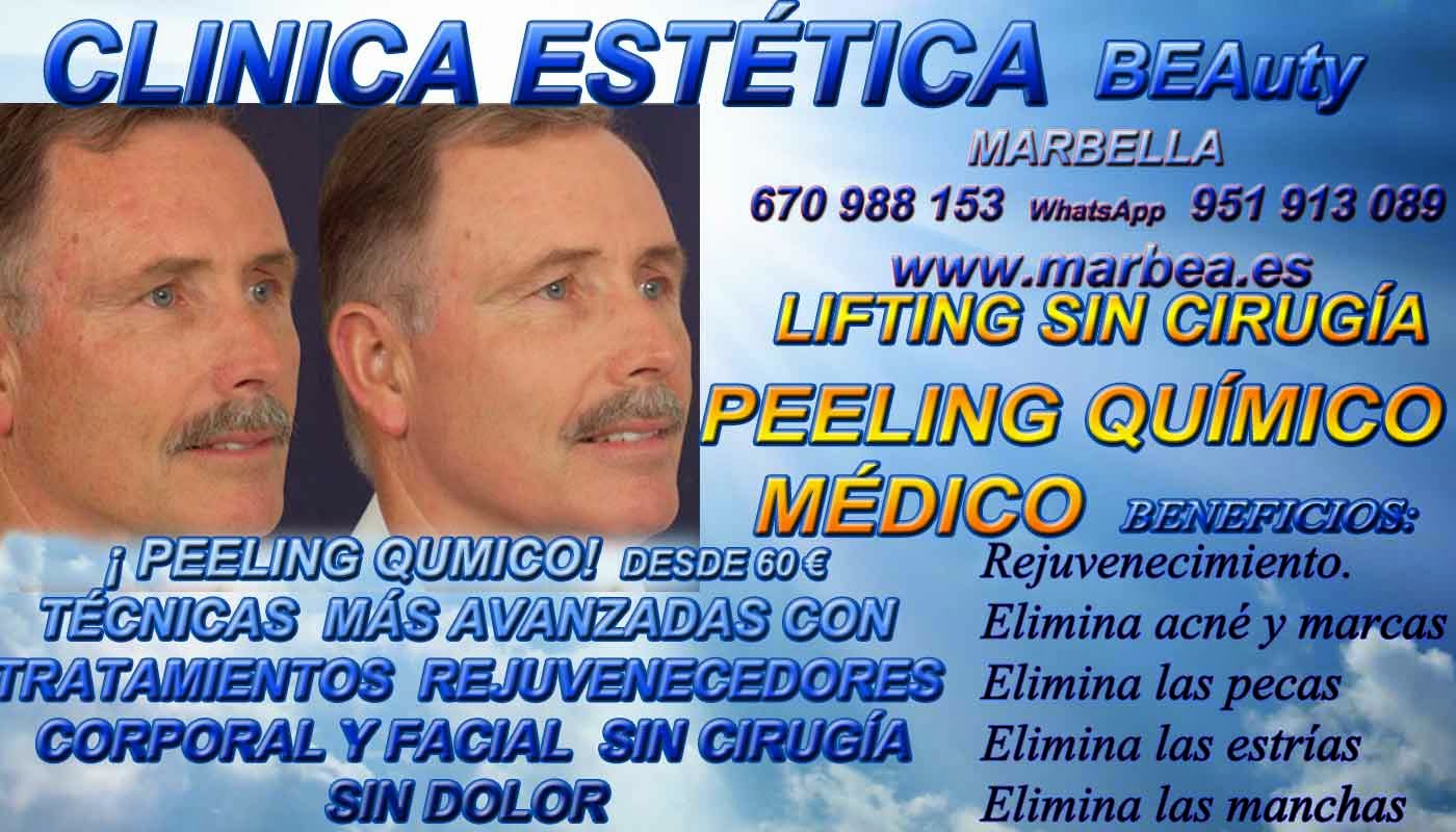 MARBELLA PEELING FACIAL QUIMICO  MARBELLA PEELING FACIAL QUIMICO MEDICO PARA ELIMINACIÓN , QUITAR , TRATAMIENTO: ACNÉ , MARCAS , CICATRICES , MANCHAS ,PECAS , ESTRÍAS , MANCHAS