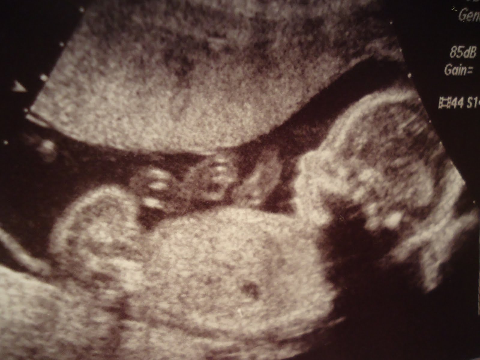 make &quot;womb&quot; for baby The 20 week Ultrasound