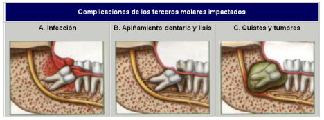 cuanto tarda en salir una muela del juicio clinica dental anna ballester 191 problemas con las muelas cuanto tarda en salir una muela del juicio clinica dental anna ballester 191 problemas con las muelas