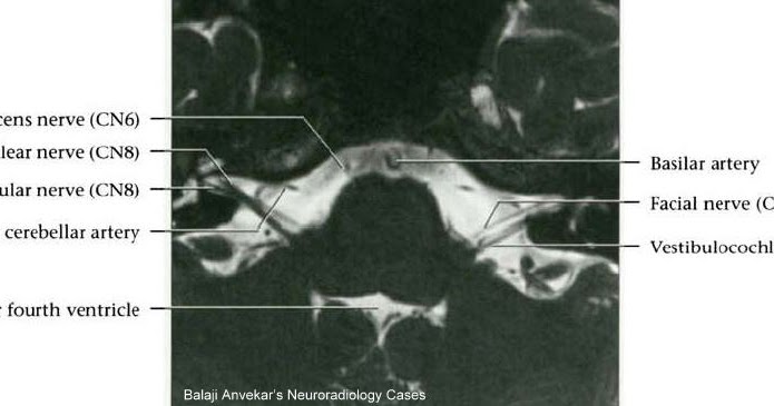 ArUn's MRI Protocols: 7TH NERVE MRI Protocol(Facial Nerve)