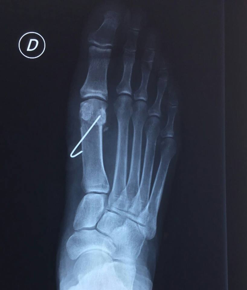Podo Basas al Día Metatarsus primus elevatus. Uña incarnada (cirugía de onicocriptosis con fenol)