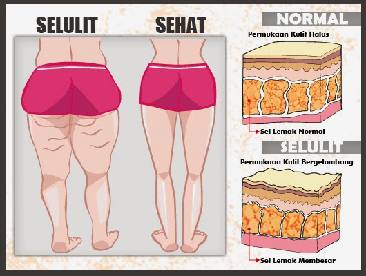 SELULIT : Cara Mengatasi