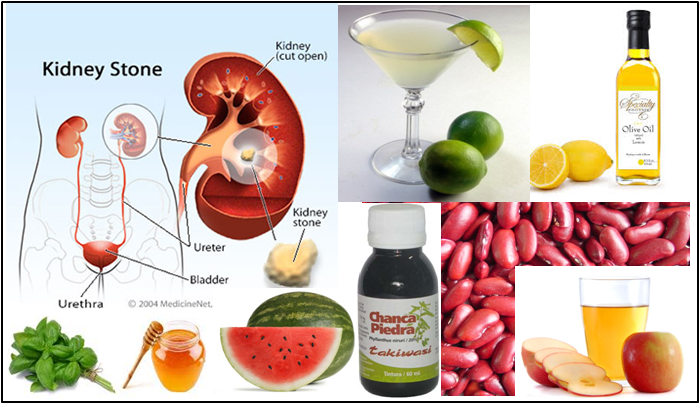 Day Night Health Book Kidney Stones Precautions And Home Remedies