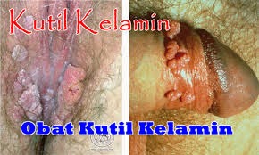 Obat Keutil Kelamin Hpv| Ampuh Terbukti Obat Keutil Kelamin Hpv| Ampuh Terbukti