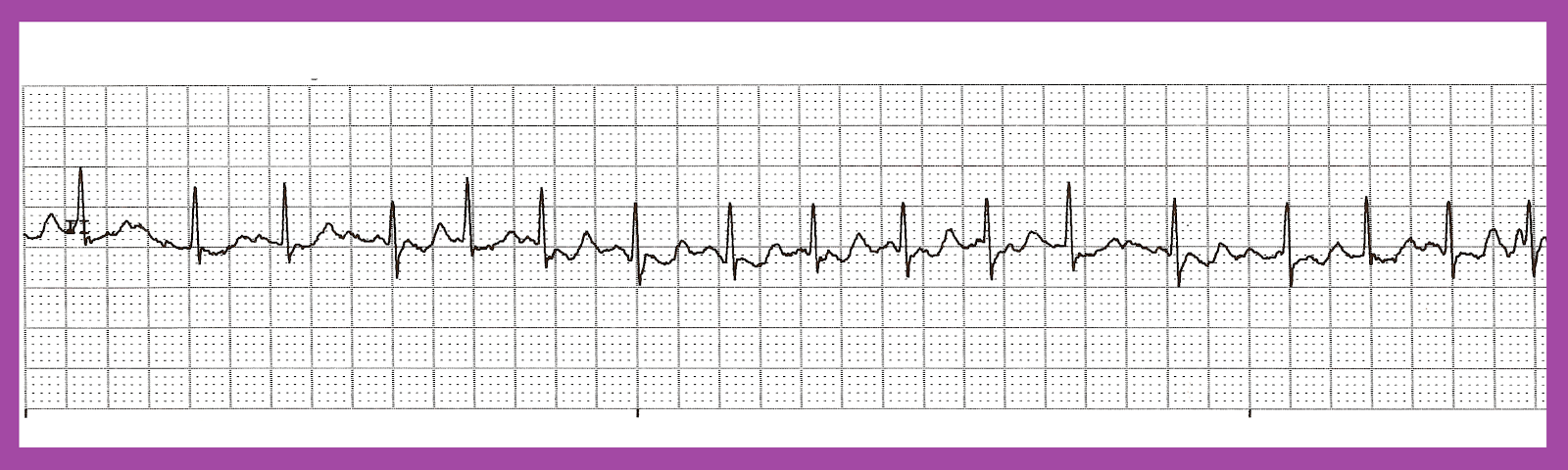 Float Nurse: EKG Rhyth...