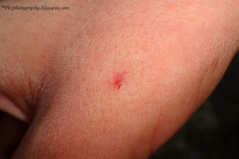 bee and wasp stings cold compress bee and wasp stings cold compress
