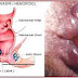 Obat Ambeien Parah thumbnail