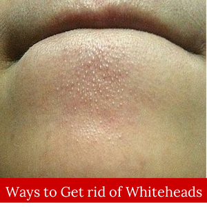 how to get rid of acne home remedies