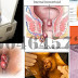 Ambeclear Apa Obat Ambeien Bentuk Peluru thumbnail