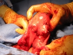 fibroid fibroid