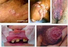 OBAT KUTIL KELAMIN OBAT KUTIL KELAMIN