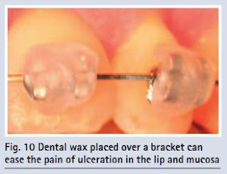 dental wax for broken tooth dental wax for broken tooth