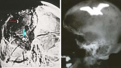 JFK-Skull-X-Ray.jpg