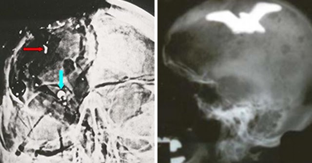 JFK-Skull-X-Ray.jpg
