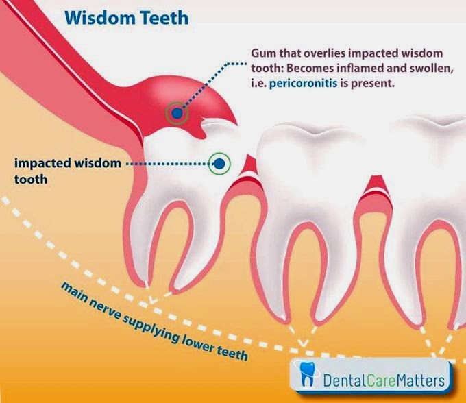 WISDOM TEETH: Image Pericoronitis by molar impacted