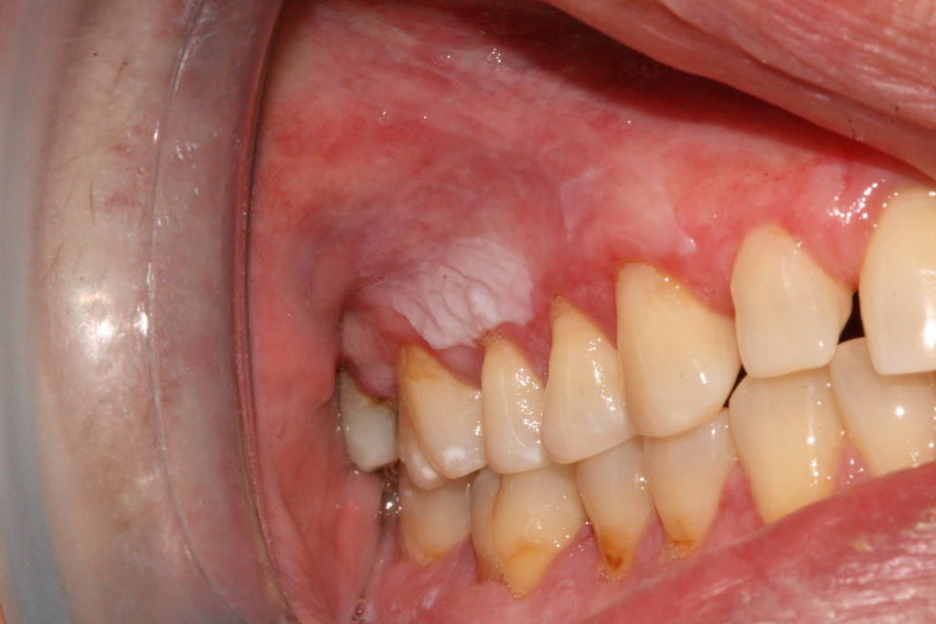 Falso Coto... Leucoplasia