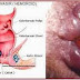 Obat Ambeien Cabe Rawit thumbnail
