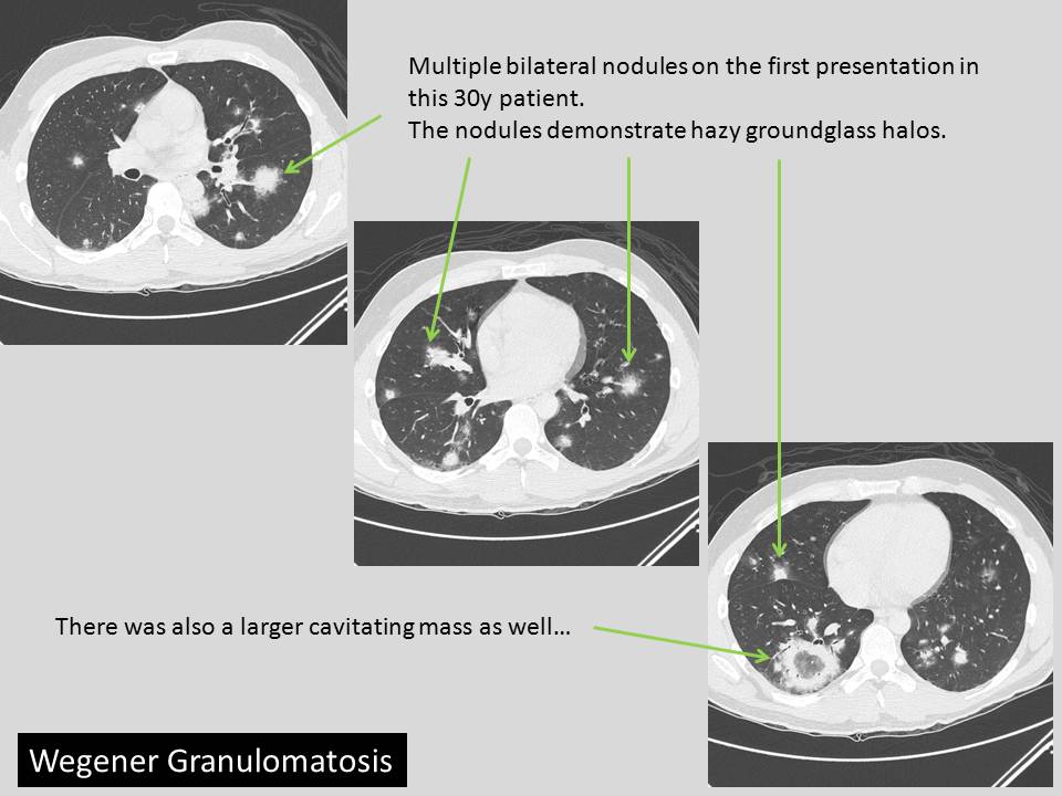 The Pump and the Tubes The Vasculitides Wegener Granulomatosis (WG)
