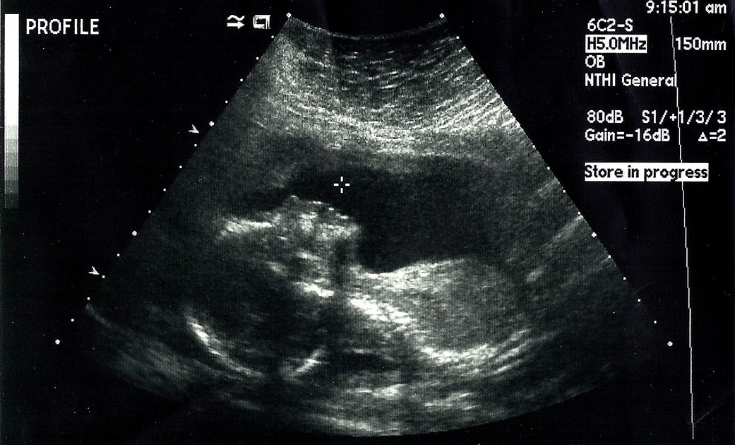The Felixtionary Ultrasound Boy or Girl?