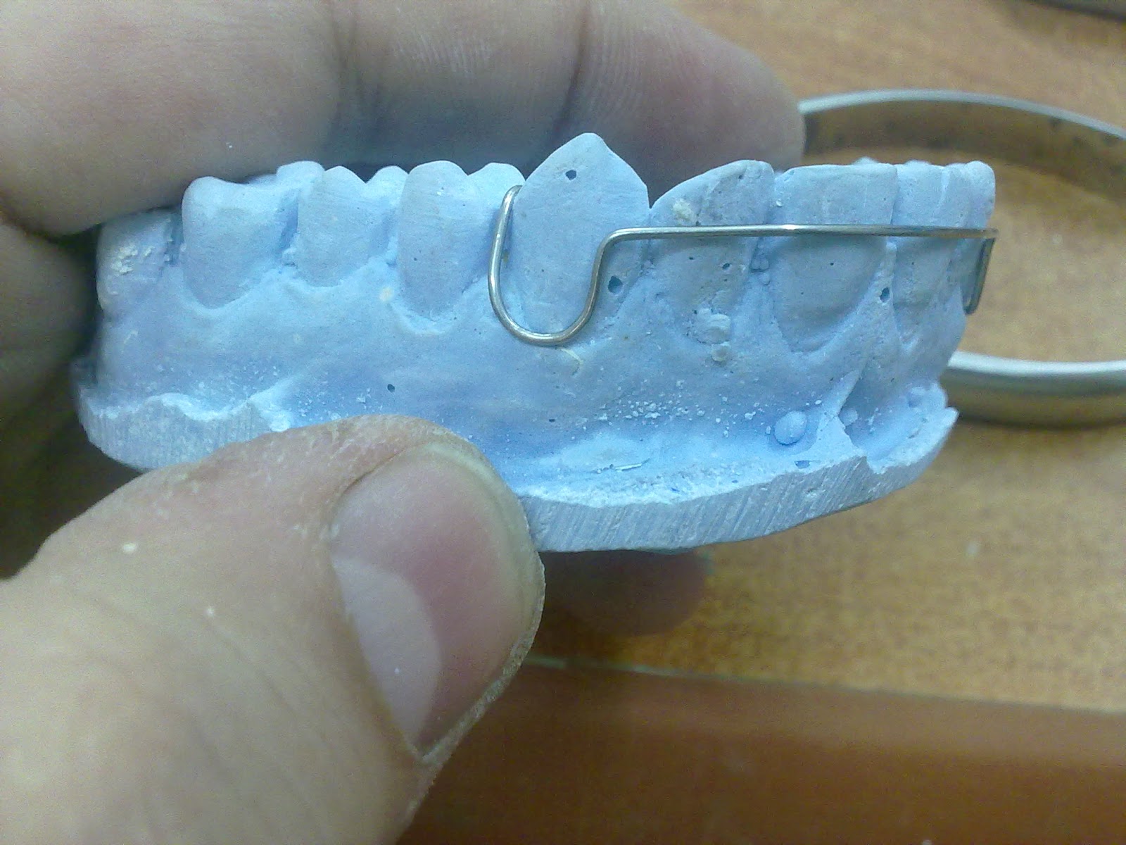 جهاز التثبيت (retainer) Smile maker