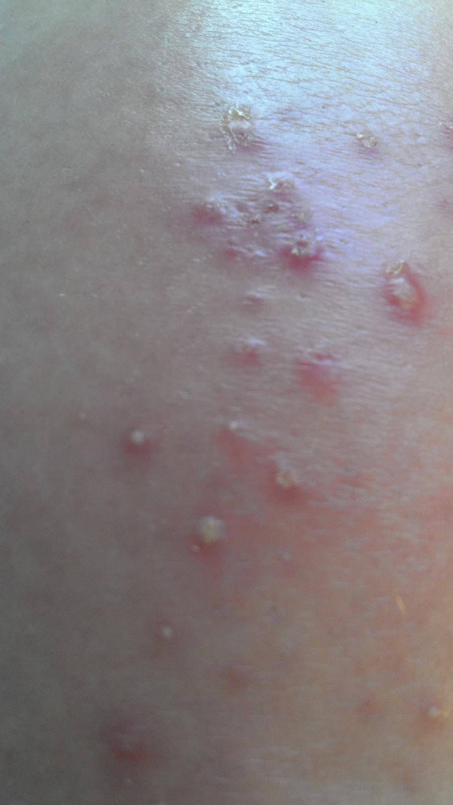 staph infection beginning of staph infection pictures to pin on pinsdaddy staph infection beginning of staph infection pictures to pin on pinsdaddy