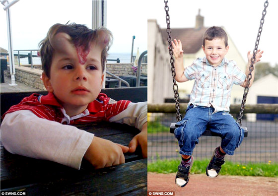 英國5歲男童除胎記 額頭長犄角神似龍人