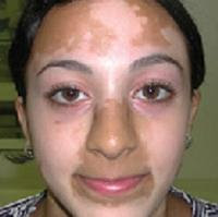 Steroid acne treatment face