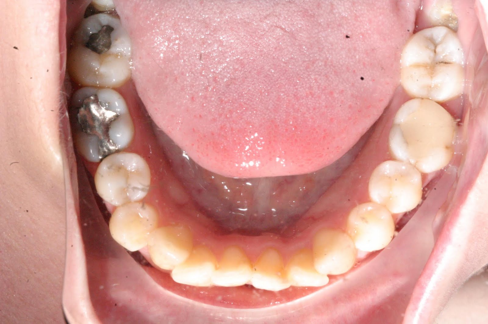 Braces + SARPE/SARME Surgery Spacers Part II & the Profile Pics...