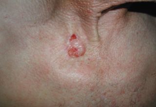 Carcinome basocellulaire Le carcinome basocellulaire est un cancer de la peau dont l'évolution est très favorable sous traitement. Les autres cancers de la peau sont le carcinome spinocellulaire et le → mélanome malin. Épidémiologie Il s'agit du plus fréquent des cancers (près de la moitié des cas) aux États-Unis et son incidence semble s'accroître. Il touche particulièrement les personnes à la peau claire (blonds ou roux) et est corrélé à l'exposition au soleil et aux rayonnements ultraviolets.