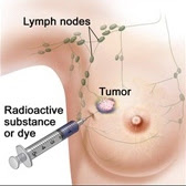 Sentinel+lymph+node+biopsy+recovery+time