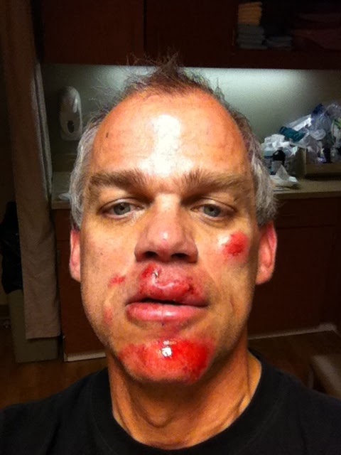 road rash face