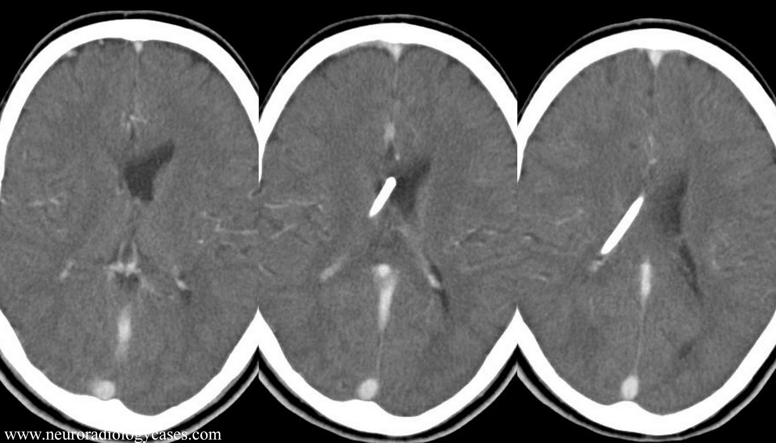 Dr Balaji Anvekar FRCR CSF shunt imaging