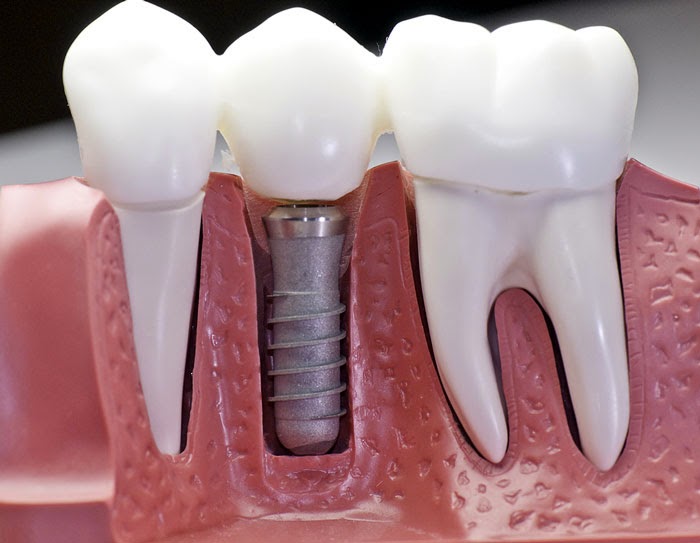 coût moyen d'un implant dentaire