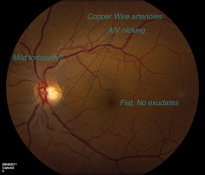 FUNdus exams: A/V nicking and other hypertensive vascular changes.