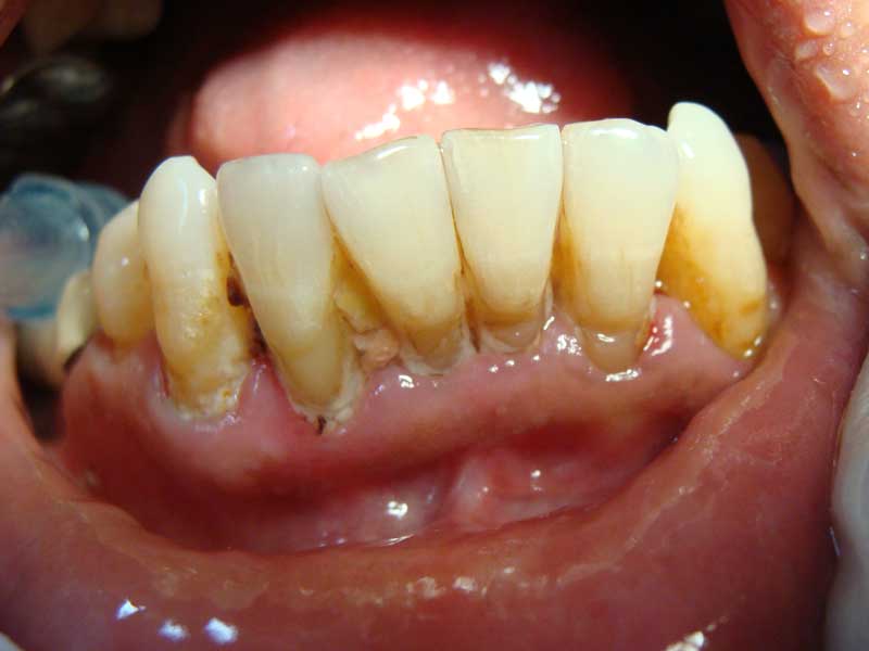 The TeethIng Troubles Oral Health a diagnosis factor for diabetes?