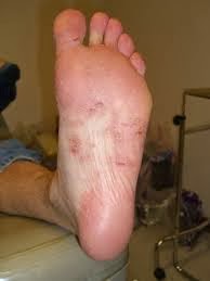 Typical Case of Athlete's Foot