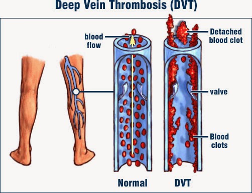 Image result for thrombophilia causes, symptoms & treatments