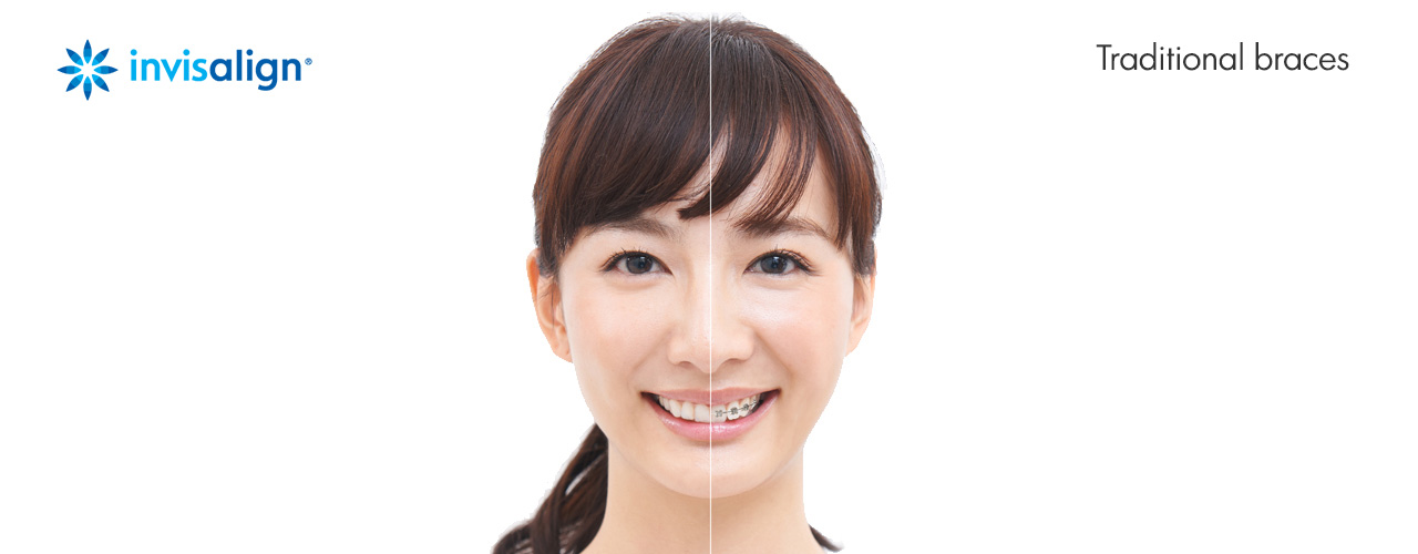 Invisalign Teeth Straightening at Heidelberg Dentist