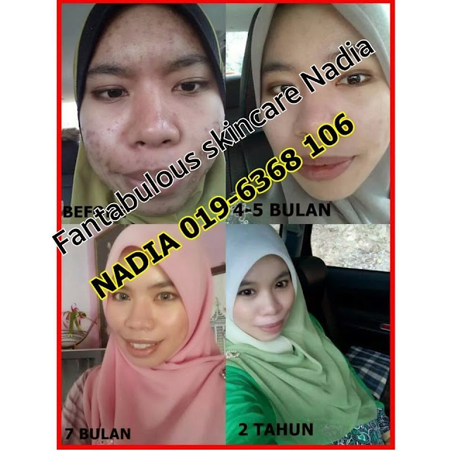 MASALAH JERAWAT,FBS,FANTABULOUS SKINCARE