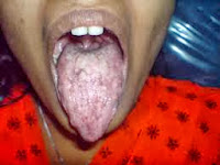 Dental Salud-lengua blanca