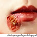 Gejala Yang Muncul Pada Penyakit Impetigo