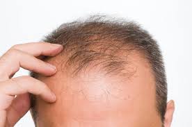 Learn the Causes and Ways to Combat Hair Loss or Baldness