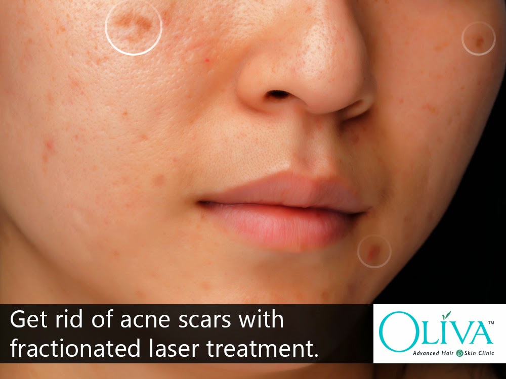 Laser Treatment for Acne Scars in Bangalore Is it Worth the Cost