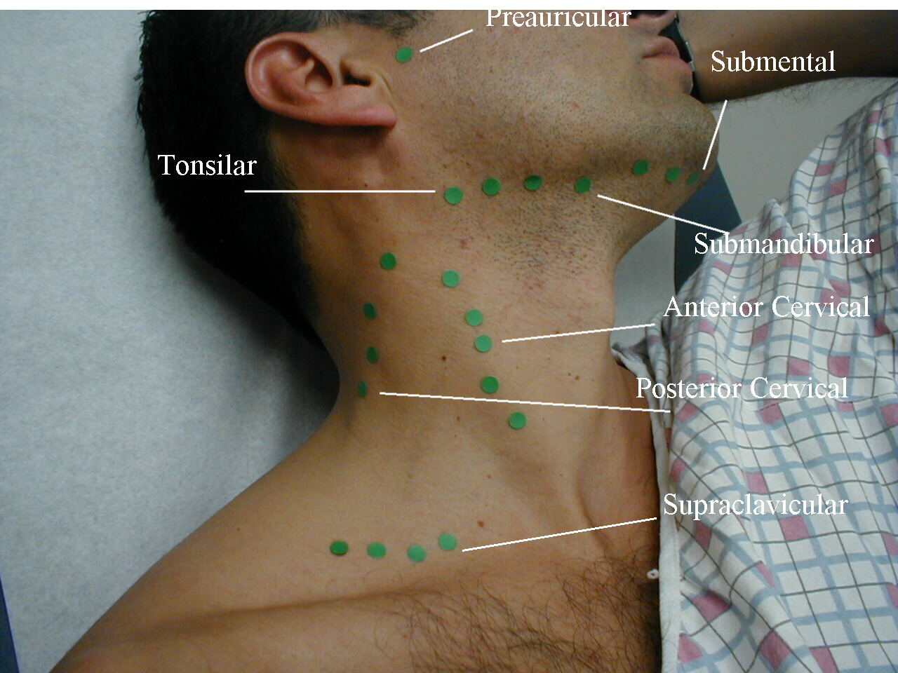 early stage cancer lymph nodes in neck early stage cancer lymph nodes in neck