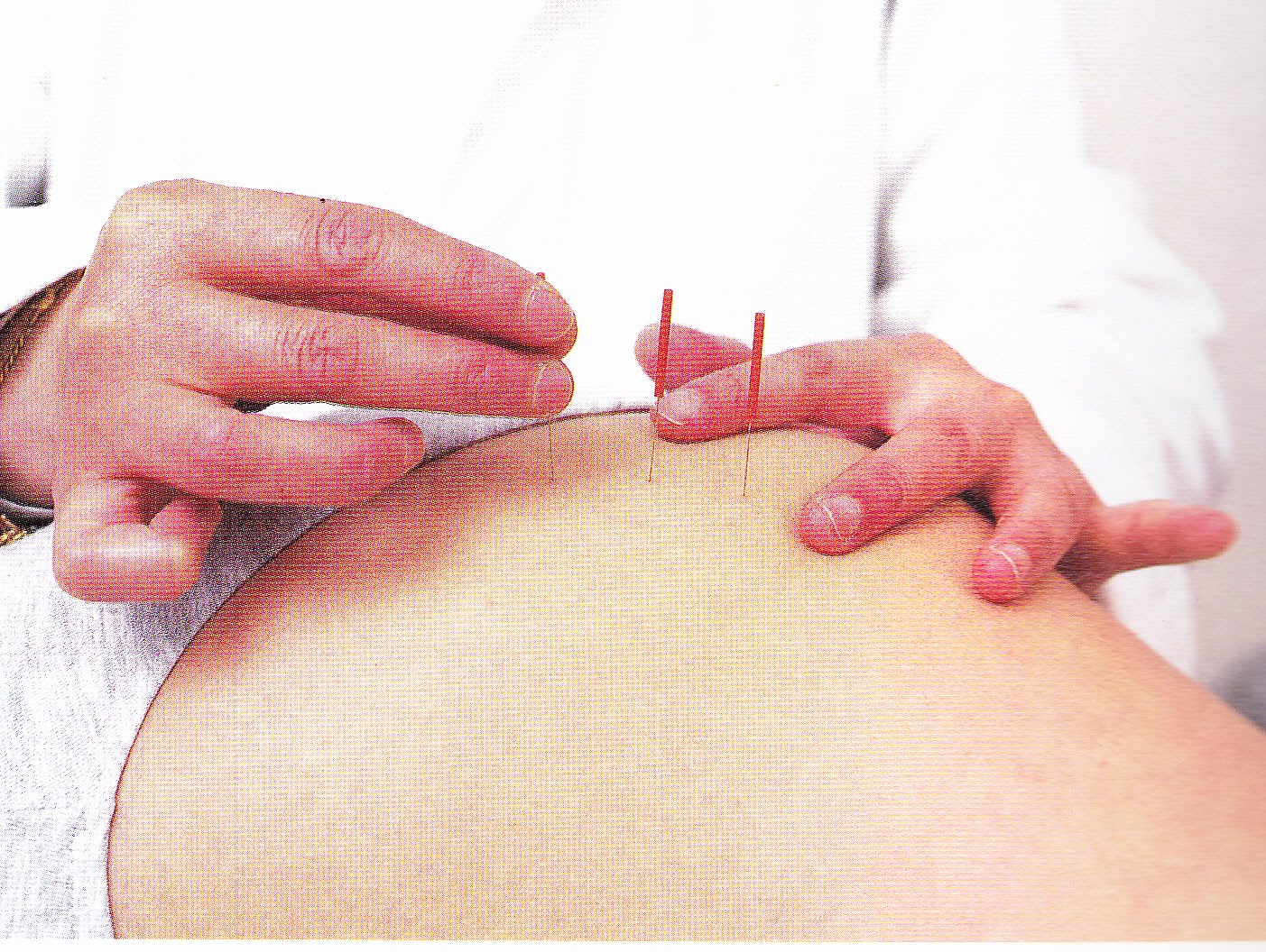 Acupuncture - Fast Get Away From Infertility