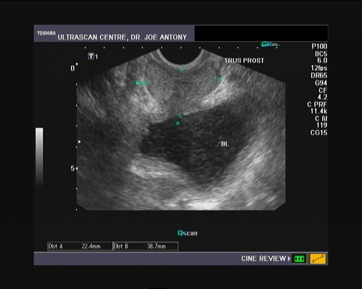 cochinblogs Kidney stones renal calculi urinary stones