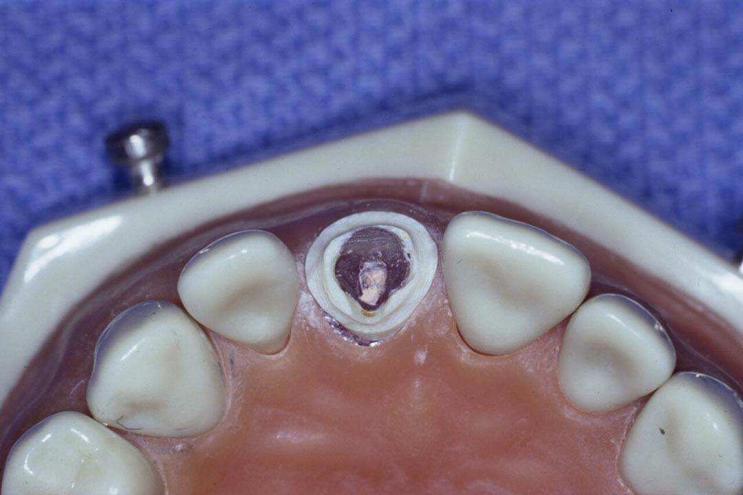 Dentistry Custom Cast Dowel Core