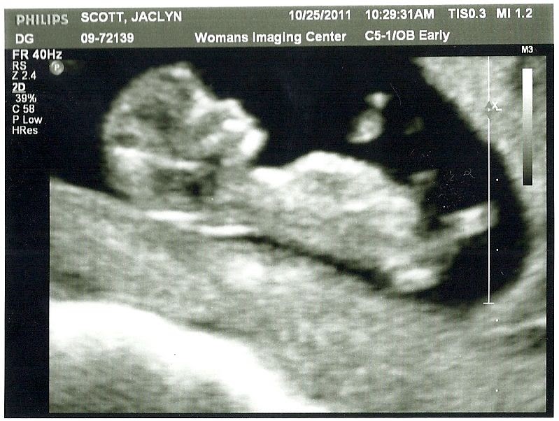 Our Scott Spot 11 Week Ultrasound