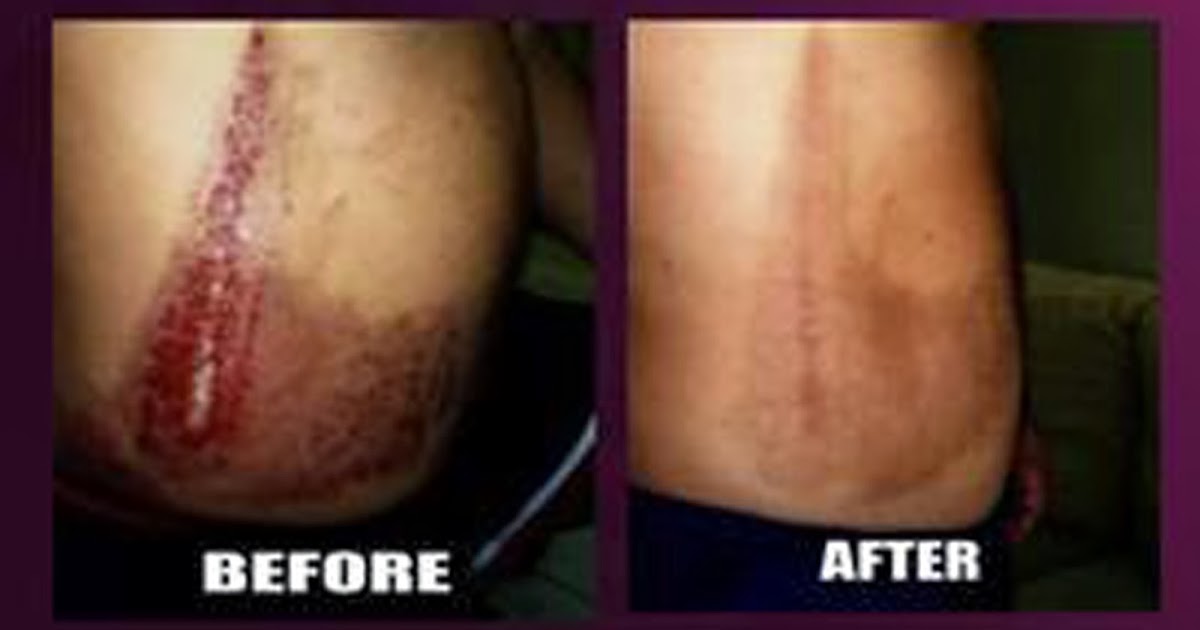 Menghilangkan parut/bekas luka, kulit kendur, selulit.